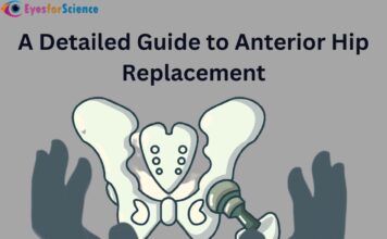 A Detailed Guide to Anterior Hip Replacement Anterior Hip Replacement