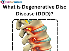 What is degenerative disc disease?