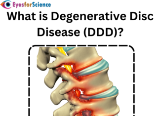 What is Degenerative Disc Disease (DDD)? What is degenerative disc disease?