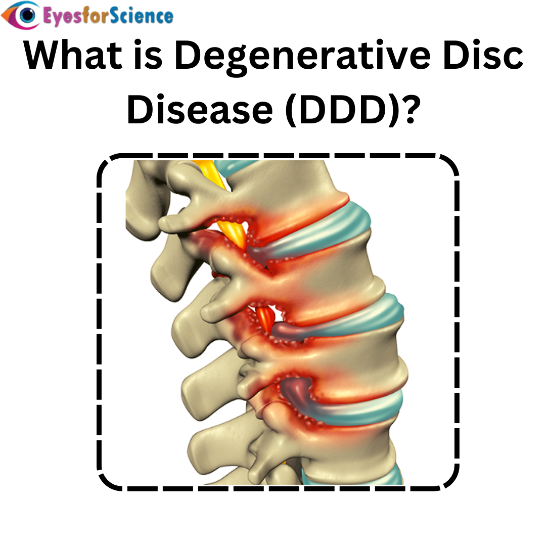 What Is Degenerative Disc Disease Ddd